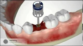 AnyRidge ScrewMentable Restoration Narrated Overview [upl. by Nhtanhoj339]