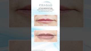 Why Hyaluronic Acid Fillers are Safer than PermanentSemiPermanent Fillers lipfiller [upl. by Namyh]