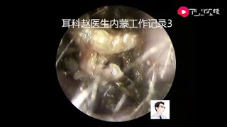 Portable otoendoscopy for cholesteatoma of external auditory canal for 10 minutes [upl. by Animas796]