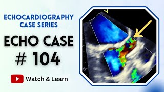 ECHO Case 104  Echocardiography for Beginners  Fever in a Child [upl. by Hahseram727]