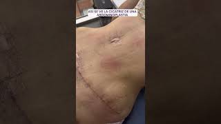 Cicatriz de una abdominoplastia  Dra lina Franco cirugiasplasticas [upl. by Ylreveb]