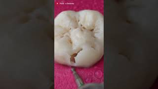 Clean Tooth or Cavity Tooth Must Watch toothrestoration dentist [upl. by Nagyam]