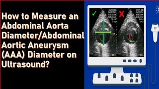 How to measure abdominal aortic aneurysm on Ultrasound [upl. by Asin]