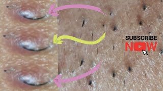 Ingrown hair  thick facial hair extraction [upl. by Posehn504]