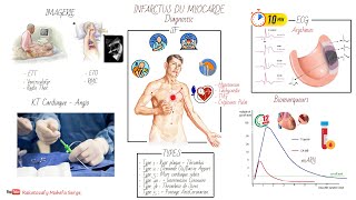 INFARCTUS DU MYOCARDE IDM  PHYSIOPATHOLOGIE ET DIAGNOSTIC [upl. by Anitsyrhk133]