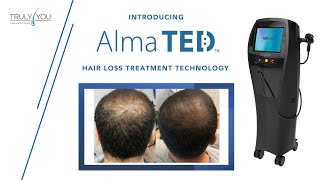 quotAlma TEDquot  Hair Loss Treatment Technology [upl. by Htiekram]