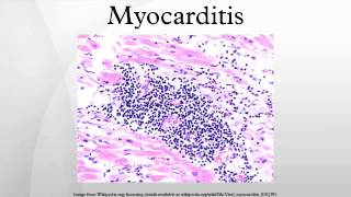 Myocarditis [upl. by Onairam]