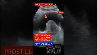 Ultrasound showing Enlarged prostateprostatomegaly ultrasound [upl. by Osana]