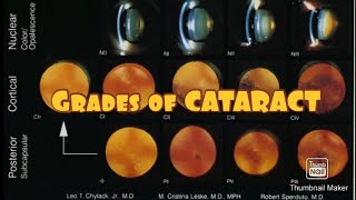 Grades of CATARACT 👀 [upl. by Ahsat]