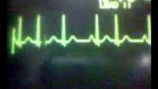 ECG Video Ectopics  Junctional [upl. by Emoryt]