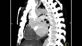 Cardiac Type B Dissection as well as Coronary Artery Disease 2 of 7 [upl. by Scholz]