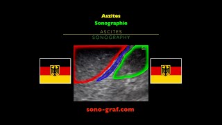 Sonographie Aszites [upl. by Edwina]