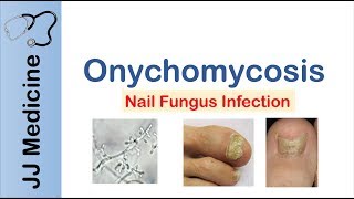 Onychomycosis  Nail Infection  Signs Symptoms Treatment [upl. by Anceline]