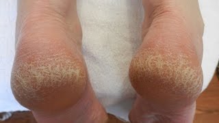 Home remedies for Cracked Heals  How to treat cracked heels [upl. by Elstan]