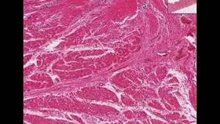 Histopathology HeartSubacute rheumatic endocarditis [upl. by Hewie]