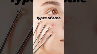 Types of acne acneskincarebeauty acneproneskin [upl. by Oberstone]