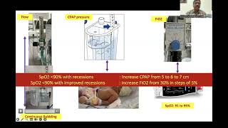 Non invasive ventilation in neonate by Dr Srinivas Murki [upl. by Lonnie]