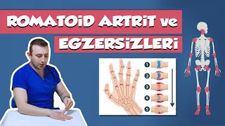 Romatoid Artrit  İltihaplı Eklem Romatizması  En Faydalı Egzersizler [upl. by Kawai797]