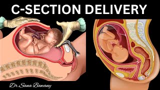 Caesarean Delivery CSection Complete Animation Video for Mommies to be [upl. by Atnicaj]