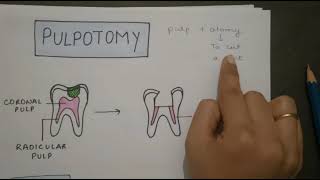 FORMOCRESOL PULPOTOMY IN HINDI [upl. by Azmah]