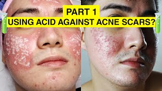 USING ACID TO GET RID OF ACNE SCARS  My TCA CROSS Experience Philippines  Envi Beauty Part 1 [upl. by Gorrian260]