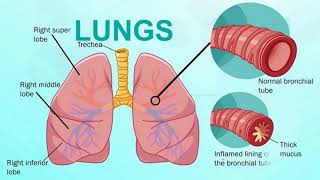 Difference Between Bronchitis and Bronchiectasis [upl. by Sorenson]