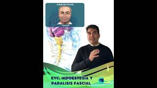 EVC HIPOESTESIS Y PARALISIS FASCIAL acv [upl. by Georgette]