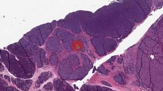 Digital Surgical Pathology pancreas Acinar Carcinoma [upl. by Ynehteb]