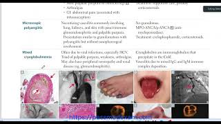 Chrug strauss syndrome with MCQ in description [upl. by Namaan359]