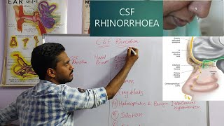 CSF RHINORRHEA  ENTNOSE [upl. by Kingsbury73]