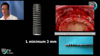 Implants Dentaires  Lexpansion osseuse [upl. by Handal]