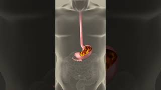 Animation What ACID REFLUX Really Looks Like Inside Your Body [upl. by Elleb]