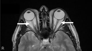 MNEMONIC  Graves Ophthalmopathy [upl. by Niamert885]