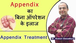 Best treatment of Appendix without operation  Appendicitis Best Treatment  अपेंडिक्स का इलाज [upl. by Kozloski313]