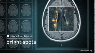 Multiple Sclerosis Understanding Your MRI [upl. by Hsur]