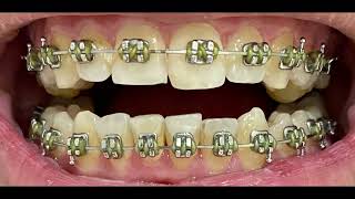 Before and After Braces timelapse over 2 Years Time monthly updates with two lower extractions [upl. by Mazonson890]