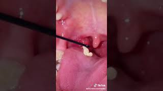 tonsil stones video [upl. by Lenoyl]