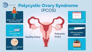 Herbal Remedy For Polycystic ovarian Syndrome PCOS [upl. by Anna-Diane]