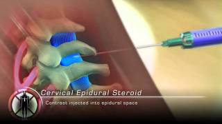 Cervical Epidural Steroid Injection Procedure Animation [upl. by Donni229]