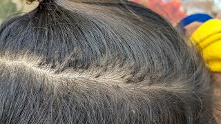 Remove thousand lice from black hair  Getting out all head lice from hair [upl. by Dorrej]