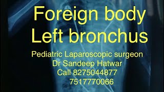 Foreign body left bronchus [upl. by Aronoel]