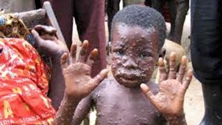 MonkeyPox Hits Nigeria [upl. by Aillicec151]