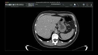 ANATOMIA SECCIONAL DO ABDOME NA TOMOGRAFIA COMPUTADORIZADA [upl. by Neibaf]