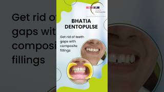 Get rid of Teeth Gaps with Composite Fillings Dr Srishti Bhatia confidentsmile healthysmile [upl. by Airbmac]