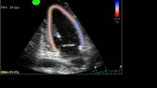 ABNORMAL STRAIN LONGITUDINAL ECHO [upl. by Leyameg]