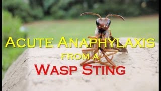 Acute Anaphylaxis from a Wasp Sting [upl. by Adnolehs]