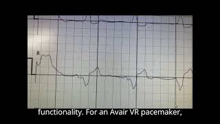 ECG after 6 months leadless pacemaker implantation Aveir VR [upl. by Okramed]