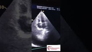 Constrictive pericarditis Echo  CP Echo  Echocardiography toacs  constrictive pericarditis [upl. by Aicella]