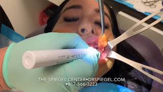 Buccal Fat Removal at The Spiegel Center [upl. by Oiznun]