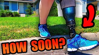 How Soon Will I Get a Prosthetic Leg After Amputation [upl. by Iaras]